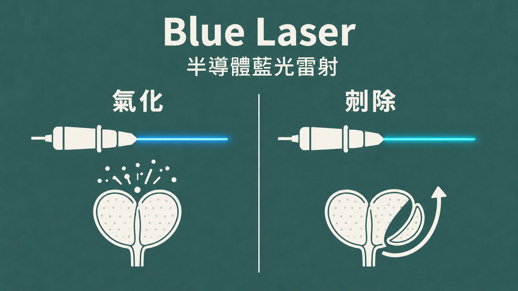 攝護腺肥大治療：告別排尿困擾，重拾順暢人生｜長安醫院泌尿科